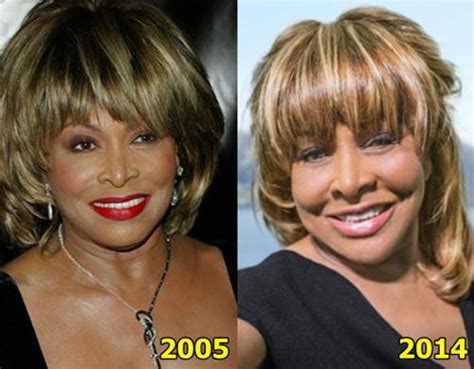 Tina Turner Plastic Surgery Before And After - Latest Plastic Surgery ...