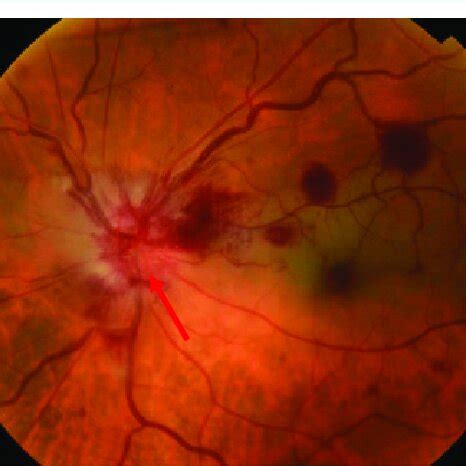 Fundus photography 3 days after first examination showed papillary ...