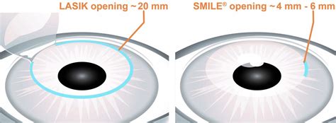Lasik Surgery
