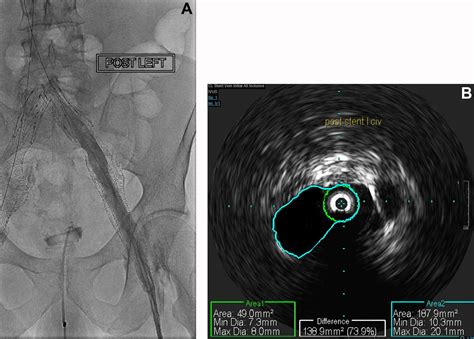 Venogram Venous Occlusive Disease