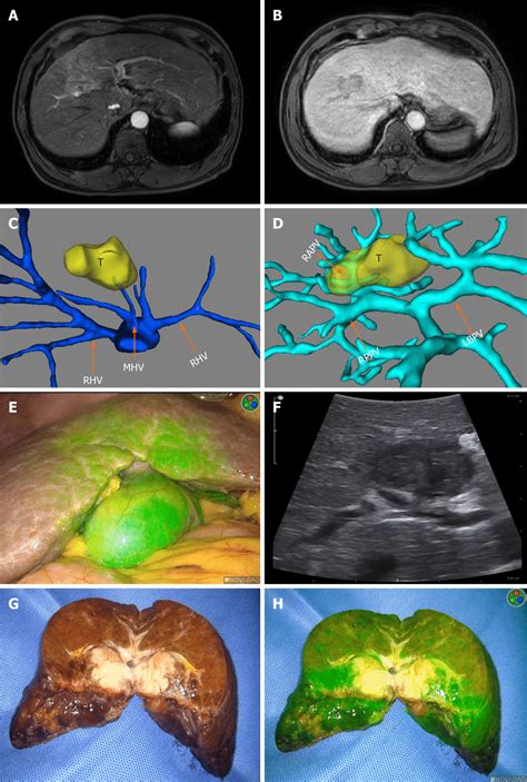 Imaging Examinations Of Case A And B Preoperative Magnetic