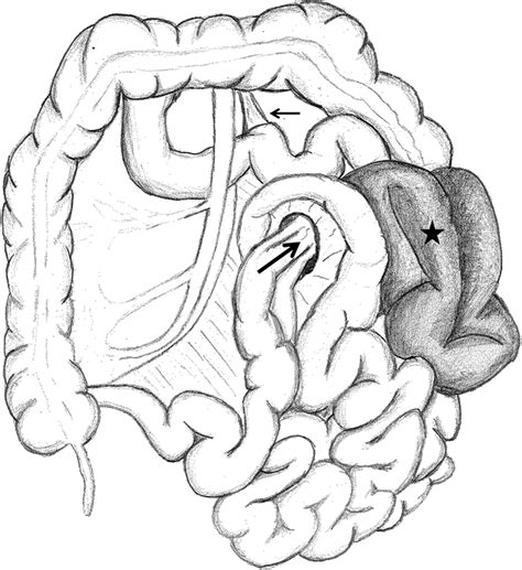 Internal Hernia As A Cause For Intestinal Obstruction In A Newborn