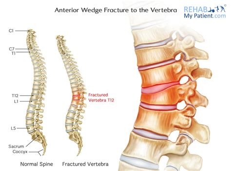 Anterior Wedge Fracture To The Vertebra Rehab My Patient