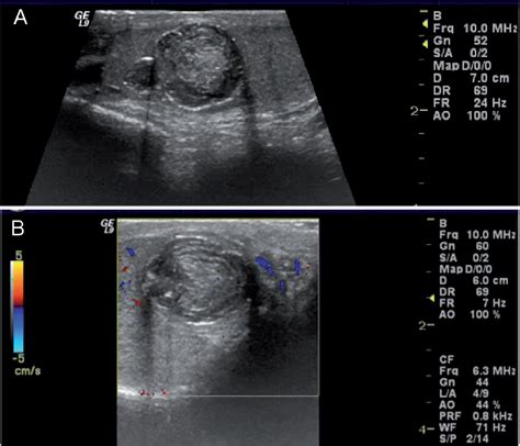 Testicular Cyst Ultrasound