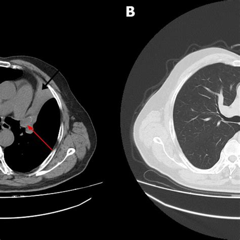 A Axial Chest CT Scan Revealing Soft Tissue Mass Measuring