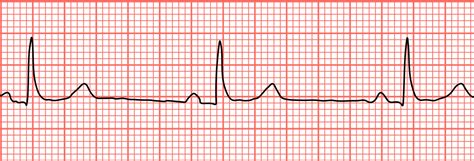 Sick Sinus Syndrome Geeky Medics