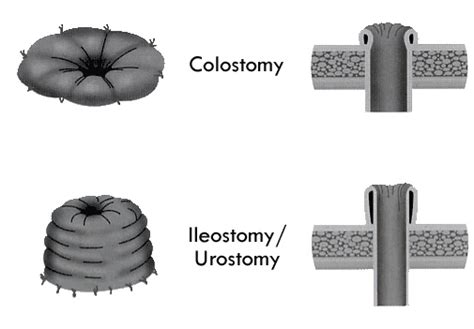 What Is A Stoma