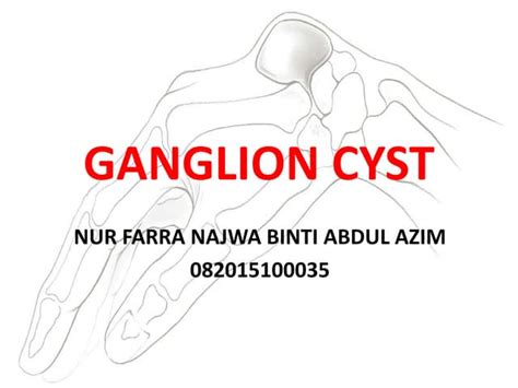 Ganglion Cyst Ppt