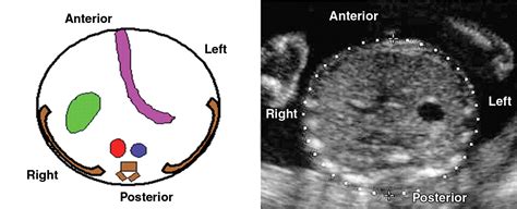 Ultrasound Of Fetal Cardiac Anomalies Ajr