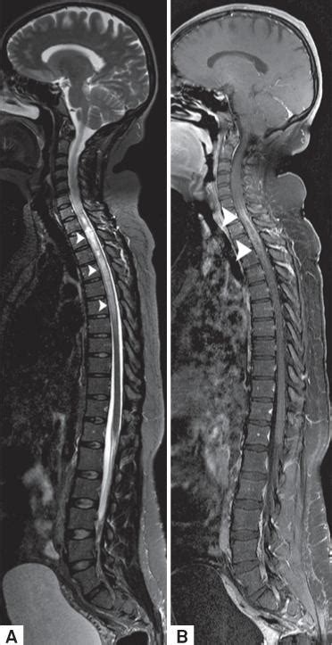 Scielo Brasil Central Nervous System Infectious Diseases Mimicking