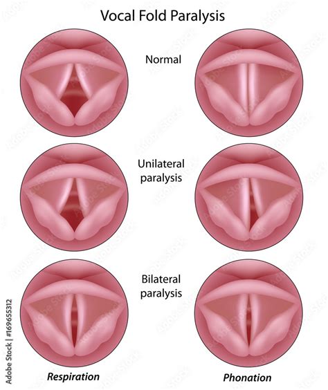 Vocal cord paralysis Stock Illustration | Adobe Stock