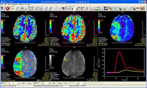 Apollo Medical Imaging Technology Stroke Mr