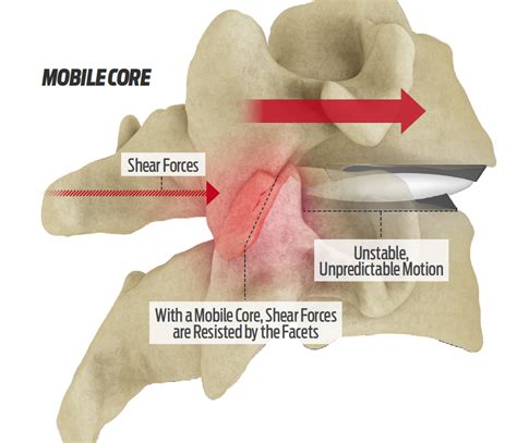 Centinel Spine For Prodisc Motion Preservation Disc Arthroplasty