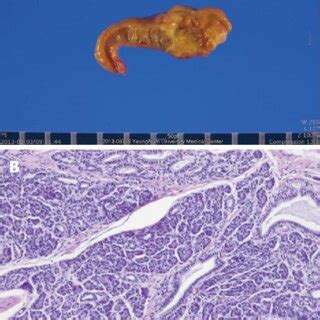 Macroscopic Finding Of The Resected Specimen A And Microscopic View