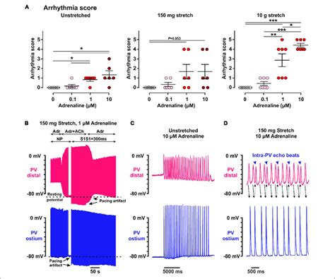 Arrhythmic Events Induced Within The Pulmonary Vein Pv Myocardium