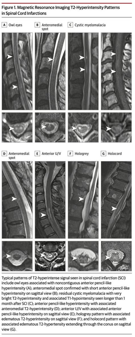 MedClub On Twitter RT CarlosJMoreno Review JAMANeuro