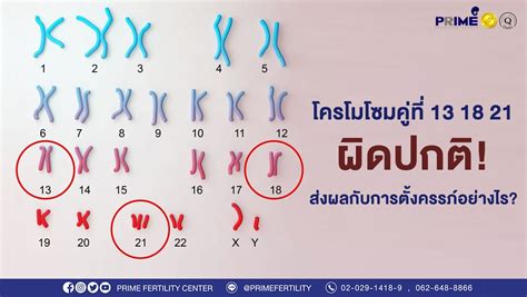 ICSI ตรวจโครโมโซม โครโมโซมคท 13 18 21 ผดปกต สงผลอยางไร