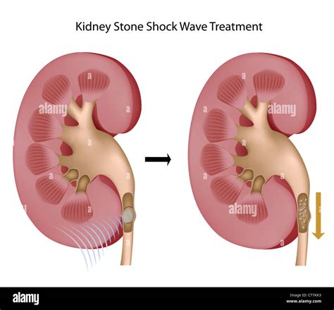 Treatment of kidney stones Stock Photo - Alamy