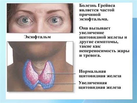 Болезнь Грейвса (диффузно-токсический зоб) - презентация онлайн