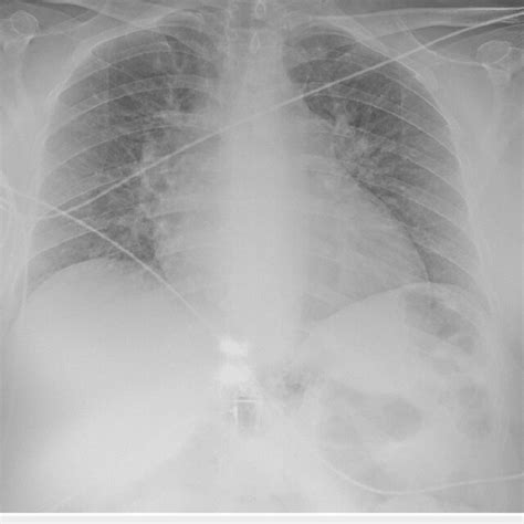 Chest Radiograph Single View Chest Radiograph In A Posteroanterior