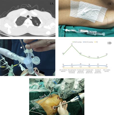 Report On The First Nonintubated Robotic Assisted Thoracic Surgery