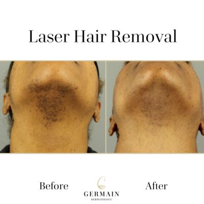 Laser Hair Removal Treatment | Mt Pleasant, at South Carolina