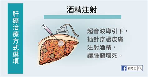 如何治療肝癌？（懶人包） 照護線上