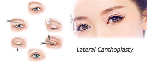 Lateral Canthoplasty Nobel Medical Group