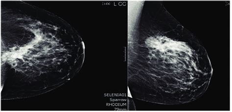 Mammogram. A core biopsy was done of this mass and it showed poorly ...