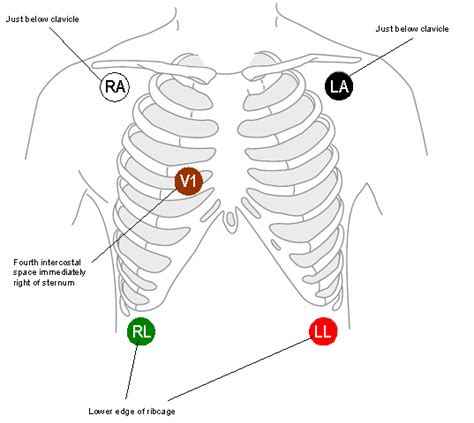 Cardiac Monitor 5 Lead Telemetry Placement