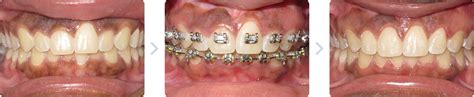 Soft Tissue Laser - VanderWall Orthodontics