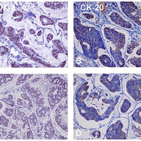 Expression Of Cdx And Ck In The Tumor Tissues Of Lymphatic A And