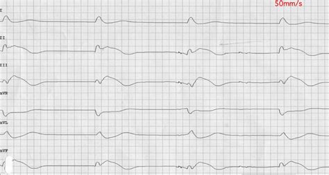 Bezpulzová elektrická aktivita EKG Medicína nemoci studium na 1