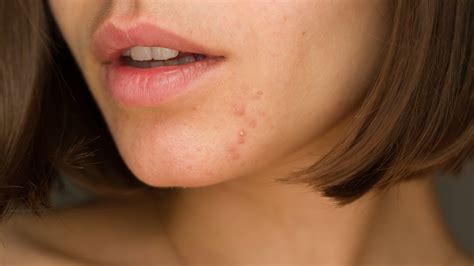 Accutane Side Effects Lips