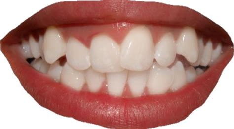 Straighten Teeth — Dentist Melbourne Invisalign Teeth Whitening