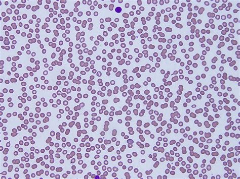 Hemoglobin Variants Blood Tests