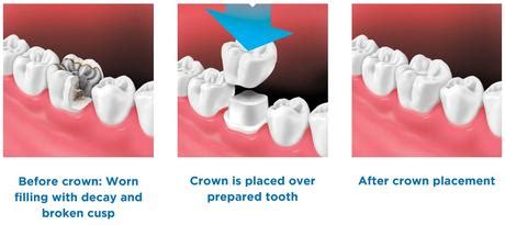 Affordable Jacket Crowns in Metro Manila - DentaGem Dental Clinics