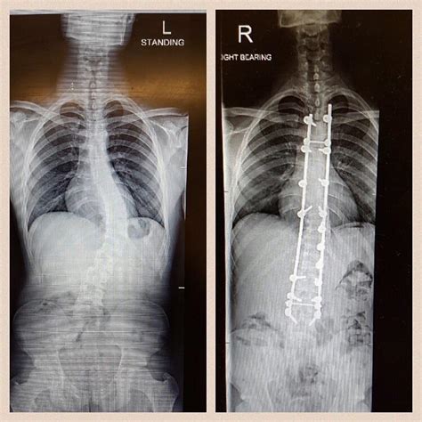 Before After Spinal Fusion Surgery For Scoliosis Pics Sexiz Pix