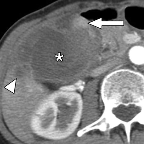 Gallbladder Carcinoma Ultrasound