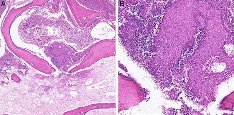 Actinomycosis Arising From The Nasal Cavity With Rare Fatal Progression Bmj Case Reports