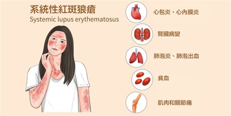 肥胡醫聊 紅斑狼瘡會致命？年輕女士最高危？港大醫學院院長劉澤星話你知 香港 大公文匯網