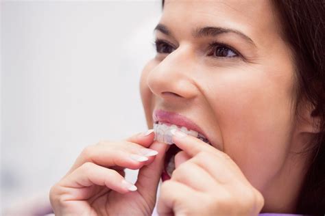 The Invisalign Experience A Step By Step Guide To Straighter Teeth