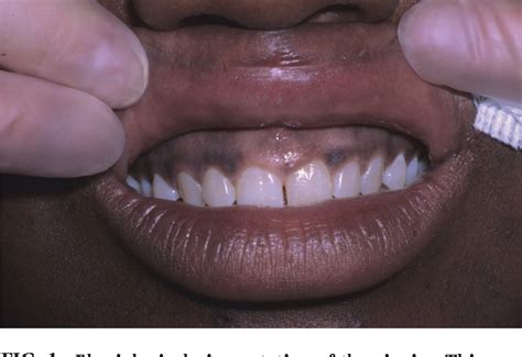 Figure 1 From Melanin Associated Pigmented Lesions Of The Oral Mucosa