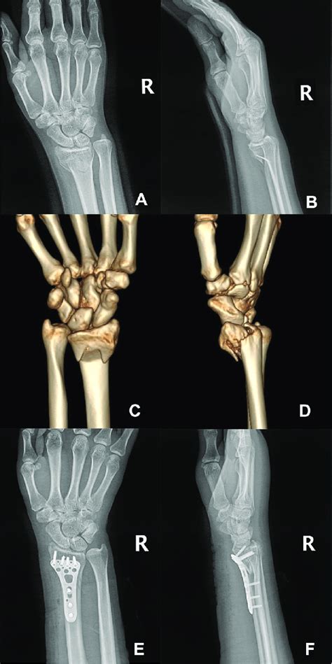 Preoperative X Ray Films A And B And Three Dimensional Reconstructive