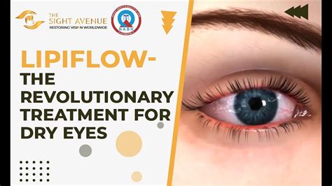 Lipiflow The Revolutionary Treatment For Dry Eyes At The Sight Avenue Youtube