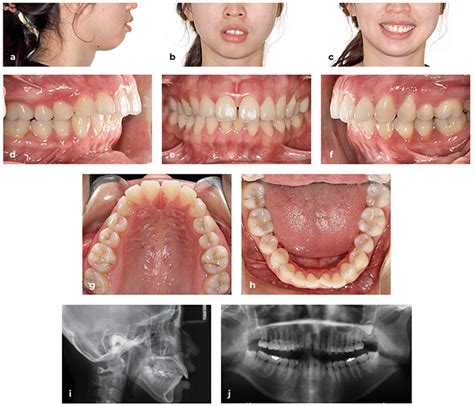 Clear Aligner Technique Bringing Orthodontic Treatment Into The Digital Era Quintessence