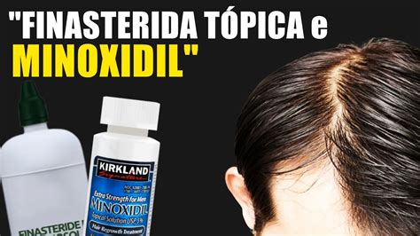 Finasterida T Pica Minoxidil Para Tratar Calvicie Masculina Youtube