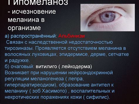 Когда наблюдается распространенный гипермеланоз? Гипомеланоз ...