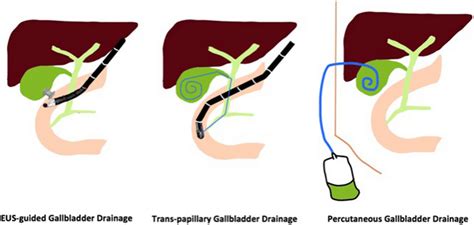 Procedural Diagram Of Eus Guided Transmural Erc Assisted Download