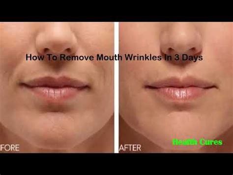 How To Remove Mouth Wrinkles In 3 Days Inexpensive Ways To Get Rid Of